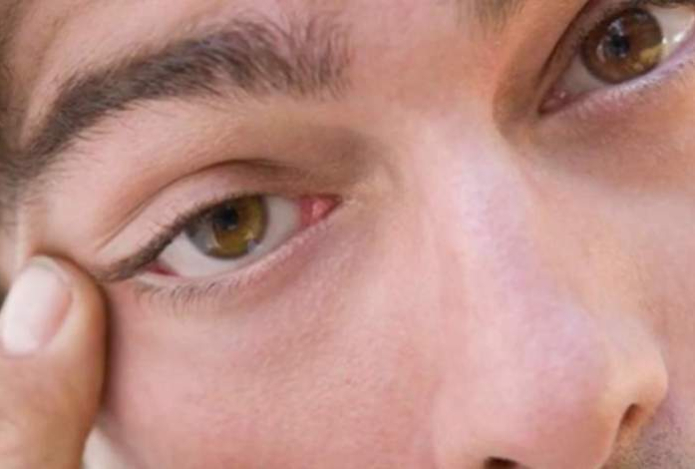 Причины блефароспазма