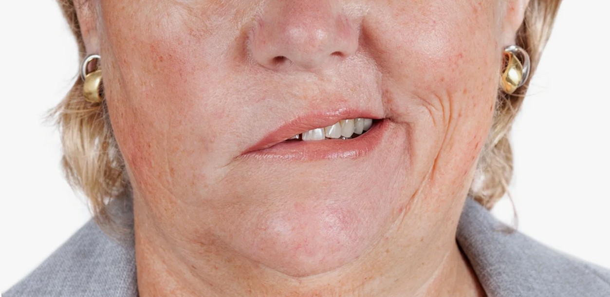 Гемифациальный спазм