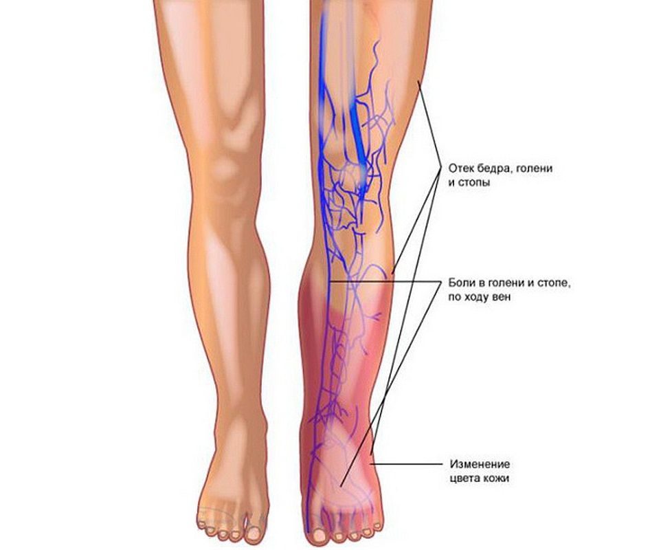 Тромбофлебит
