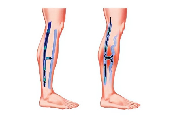 посттромбофлебитическая болезнь